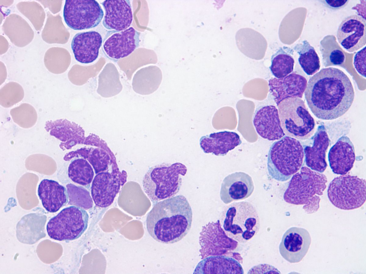 Bone marrow aspirate: Small to intermediate sized blasts.